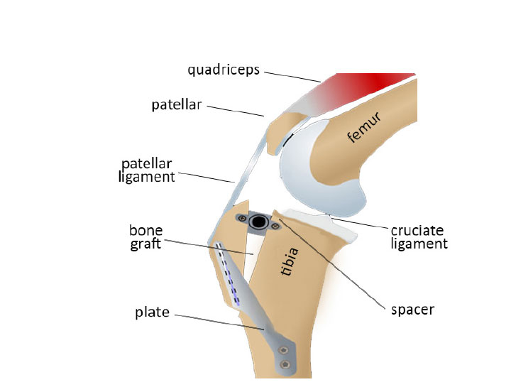 Tibial Tuberosity Advancement (TTA)